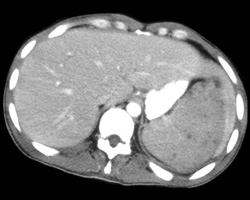 Splenic Lymphoma - CTisus CT Scan