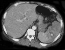 Splenic Infarction - CTisus CT Scan