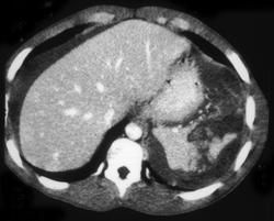 Splenic Laceration - CTisus CT Scan