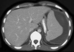 Subcapsular Hematoma-mononucleosis - CTisus CT Scan