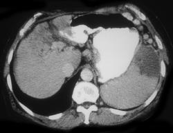 Splenic Infarction With Portal Hypertension - CTisus CT Scan