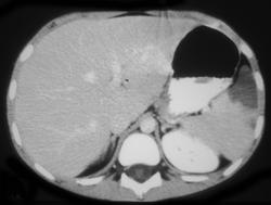 Splenic Infarction - CTisus CT Scan