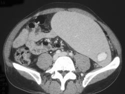 Acute Hemorrhagic Splenic Infarction - CTisus CT Scan