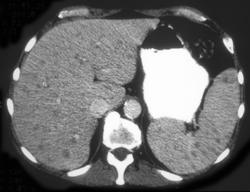 Candidiasis - CTisus CT Scan