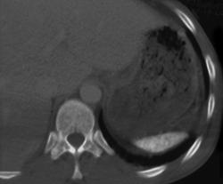 Sickle Cell Disease - CTisus CT Scan