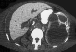 Sickle Cell Disease With Cystic Changes - CTisus CT Scan