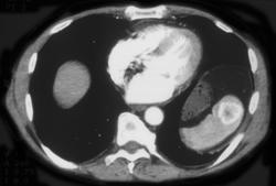 Splenic Hemangioma - CTisus CT Scan