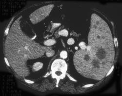 Lymphoma - CTisus CT Scan