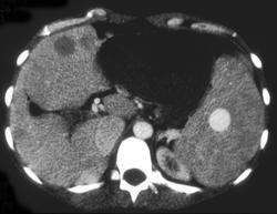 Splenic Hemangioma - CTisus CT Scan