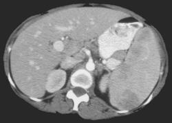 Splenic Lymphoma - CTisus CT Scan