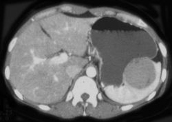 Splenic Hamartoma - CTisus CT Scan