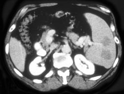 Splenic Lymphoma - CTisus CT Scan