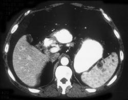 Splenic Hemangiomas - CTisus CT Scan