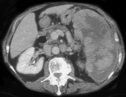 Splenic Lymphoma With Active Bleed - CTisus CT Scan