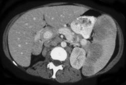 Splenic Sarcoid (note: Looks Identical to Lymphoma) - CTisus CT Scan