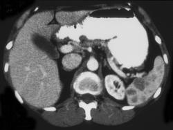 Splenic Hemangiomas - CTisus CT Scan