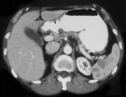 Splenic Hemangiomas - CTisus CT Scan