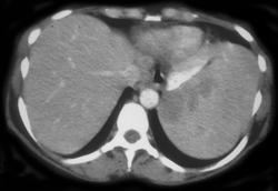 Splenic Lymphoma - CTisus CT Scan