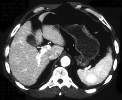 Splenic Hemangioma - CTisus CT Scan