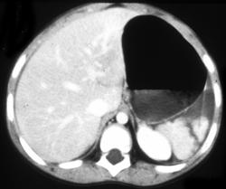 Splenic Laceration With Blood in the Pelvis - CTisus CT Scan