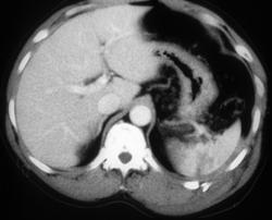 Splenic Laceration - CTisus CT Scan