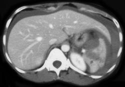 Splenic Laceration - CTisus CT Scan