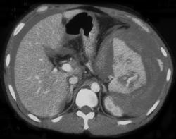 Splenic Laceration - CTisus CT Scan