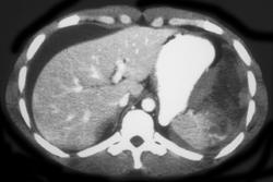 Splenic Laceration - CTisus CT Scan