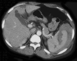 Splenic Laceration With Bleed - CTisus CT Scan