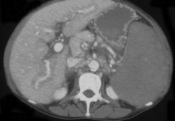 Splenic Lymphoma - CTisus CT Scan