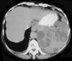 Splenic Lymphoma - CTisus CT Scan