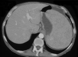 Splenic Lymphoma - CTisus CT Scan