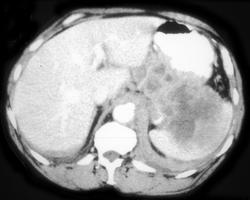 Splenic Infiltration By Lymphoma - CTisus CT Scan