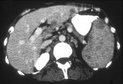 Splenic Lymphoma - CTisus CT Scan