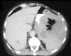 Splenic Lymphoma Simulating A Splenic Abscess - CTisus CT Scan