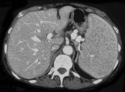 Splenic Lymphoma - CTisus CT Scan