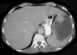 Splenic Infarction in Patient With Lymphoma - CTisus CT Scan