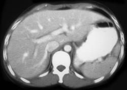 Subtle Splenic Laceration - CTisus CT Scan