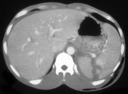 Splenic Laceration - CTisus CT Scan