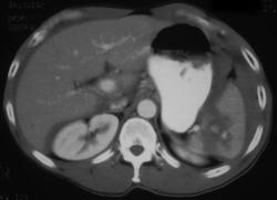 Splenic Laceration With Active Bleeding - CTisus CT Scan