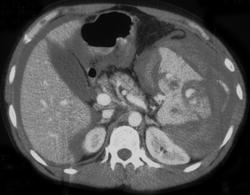 Active Bleed in A Splenic Laceration - CTisus CT Scan