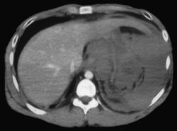 Ruptured Spleen - CTisus CT Scan