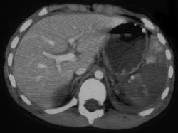 Infarcted Spleen and Kidney Due to Avulsion of Both Splenic Artery and Renal Artery - CTisus CT Scan