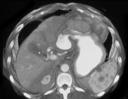 Splenic Hemangioma - CTisus CT Scan