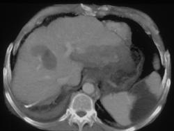 Splenic Infarction - CTisus CT Scan