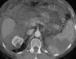 Splenic Infarction - CTisus CT Scan