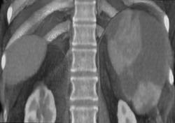 Splenic Infarction - CTisus CT Scan