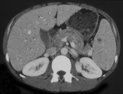 Lymphoma - CTisus CT Scan