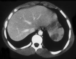 Splenic Laceration - CTisus CT Scan