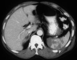 Splenic Laceration - CTisus CT Scan